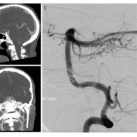 CT angiogram of the head 8.0 mm maximum intensity projections in (a ...