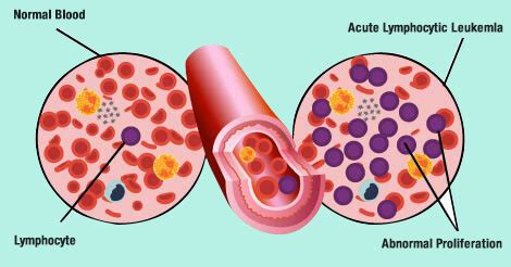 Blood Cancer | Types and Stages | Indus Health Plus