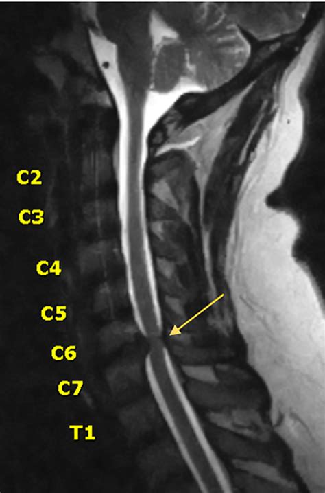 Cervical Spine Mri Comparison