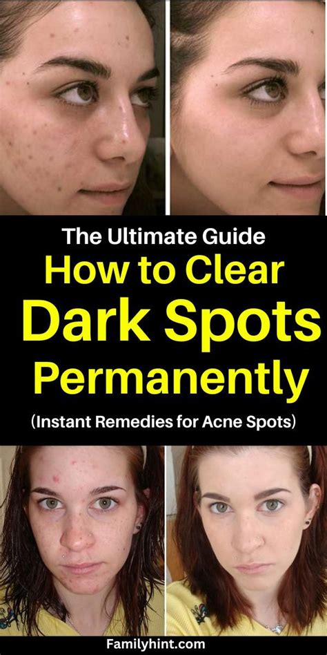 7 Home Remedies To Remove Dark Spots On Face | Dark spots on face ...