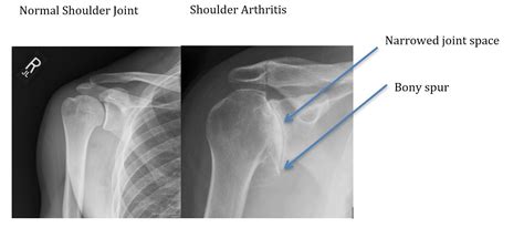 Sameer Singh | Shoulder Arthritis