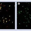 Immunohistology of human pancreatic adenocarcinoma | Download ...