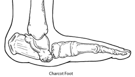 Solutions - Charcot Arthropathy — Crary Shoes