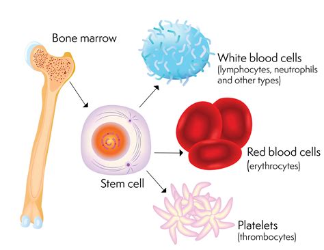 Difference between bone marrow transplant and stem cell transplant ...