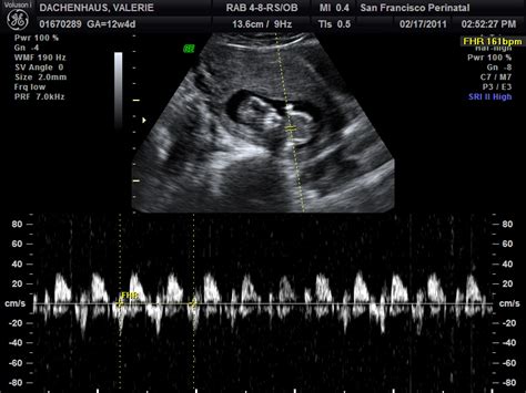 The Dachenhaus Family: Nuchal Translucency Ultrasound