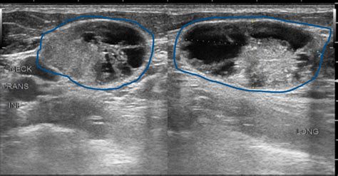 Normal Thyroid Ultrasound