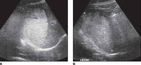 Cavernous Hemangioma Liver Ultrasound