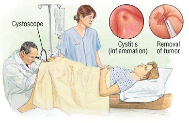 Cystoscopy Guide: Causes, Symptoms and Treatment Options