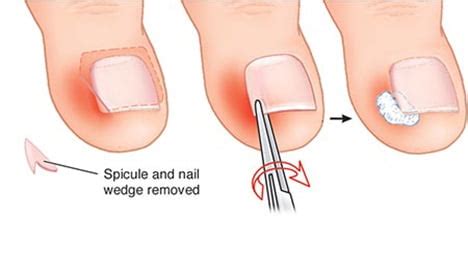 Mild Ingrown Toenail