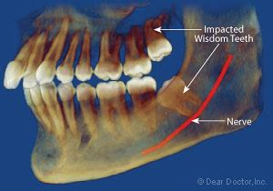 Nerve Pain: Impacted Wisdom Tooth Nerve Pain