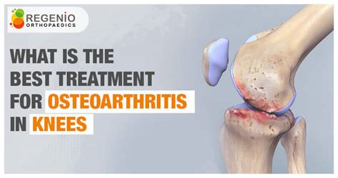 Best Treatment for Osteoarthritis in the Knees? - Regenio