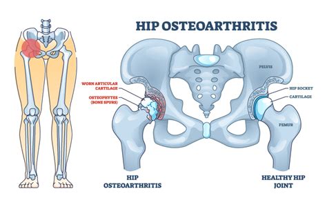 Understanding Hip Arthritis Signs and Symptoms - Sachdev Orthopaedics