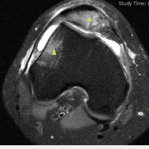 Axial T2-weighted MRI of the right knee showing the classical bone ...