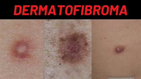 Dermatofibroma Causes, Symptoms, What is it? How is it treated? (Benign ...