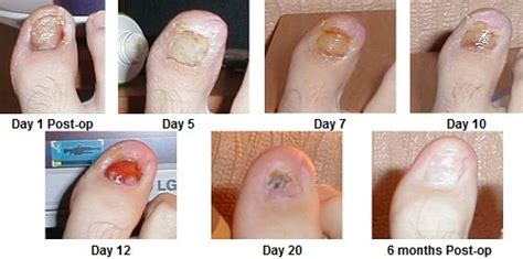 Ingrown Toenail Treatment, Causes & Prevention - Foot Pain Explored