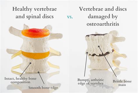 Spinal Osteoarthritis Causes, Symptoms and Treatment - Spinal Backrack