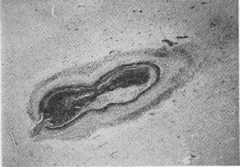 Figure 1 from The Occurrence of Angiitis and of Other Generalized ...