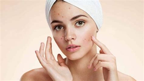 Acne woes? Follow these simple tips to keep pimples at bay | Health ...