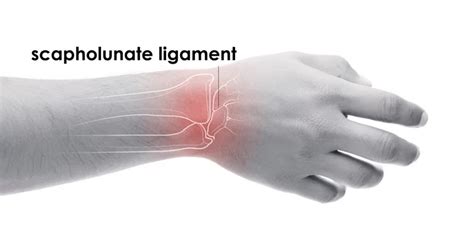 Scapholunate Ligament Tear - Torn Ligament in the Wrist | TorkLaw