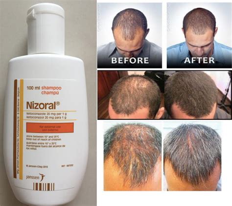 Ketoconazole Shampoo: A Miraculous Anti-dandruff And Hair-Loss Remedy