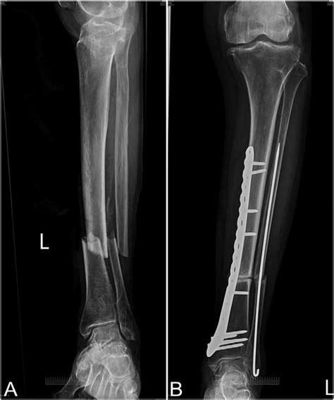 Tibia And Fibula Fracture Surgery