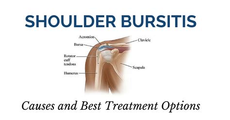 Treating Shoulder Bursitis - Niagara Shoulder Pain Clinic