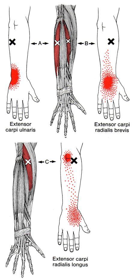 Extensor Carpi Ulnaris | The Trigger Point & Referred Pain Guide