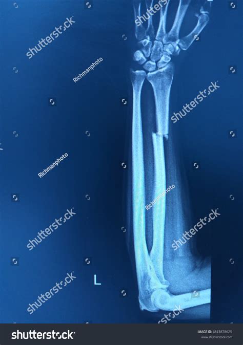 Broken arm xray Images, Stock Photos & Vectors | Shutterstock