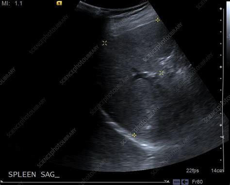 Normal spleen, ultrasound - Stock Image - C039/3197 - Science Photo Library