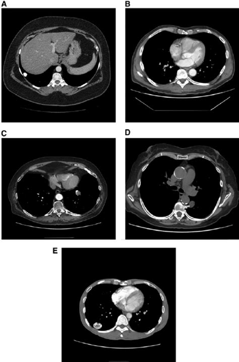 ( A ) Diffuse calcified granuloma. ( B ) Granuloma with central ...