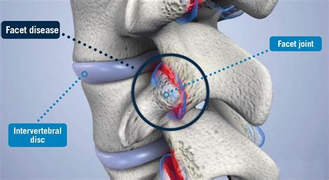 Facet Disease - USA Spine Care - Laser Spine Surgery