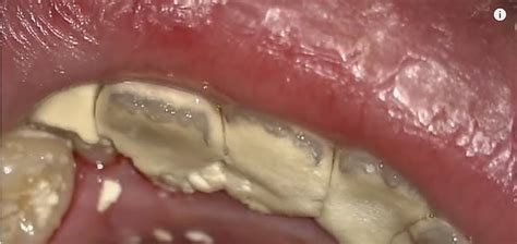 How To Remove Tartar And Dental Plaque From Teeth Naturally | Smile Widely