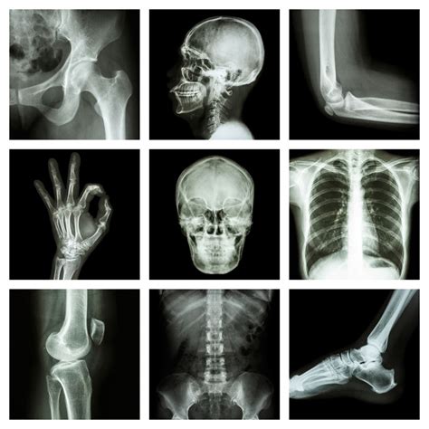 Reconsider Indications for X-Ray in Pediatric Trauma