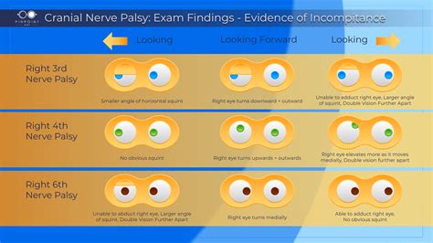 Causes for Strabismus: Cranial Nerve Palsy - PinpointEyes