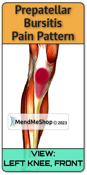 Prepatellar Bursitis: Causes Diagnosis Treatment