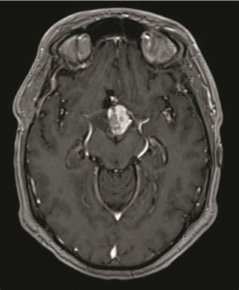 Gadolinium contrast-enhanced MRI of the brain. (a, b) First MRI after ...