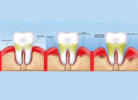 Plaque, Calculus, Tartar, Gum Disease | Pinewood Dental