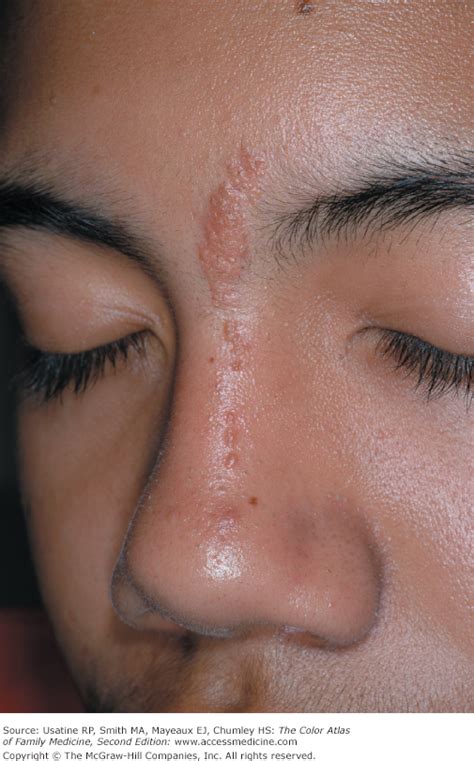 Epidermal Nevus Syndrome Symptoms - Captions Tempo