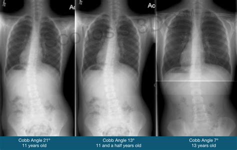 Mild Scoliosis | Mild Scoliosis Treatment Options | Don't Wait and See