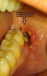 Dry Socket | Dental Clinic in Delhi