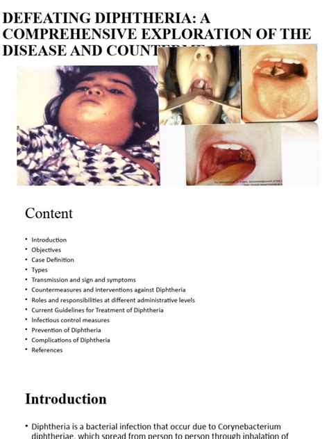 Diphtheria Presentation | PDF