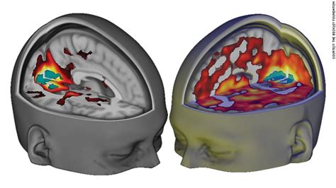 This is your brain on LSD, literally - CNN