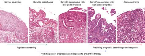 Barretts Esophagus Histology