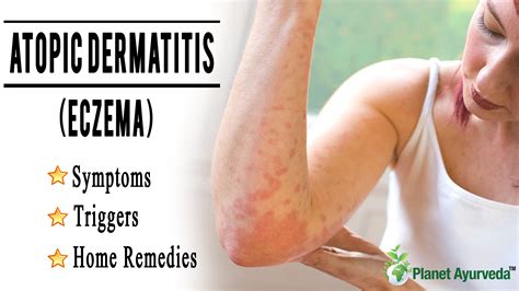 Atopic Dermatitis - Symptoms, Triggers, and Home Remedies