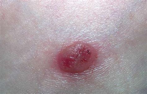 Seborrheic Keratosis - Causes, Symptoms, Home Treatment