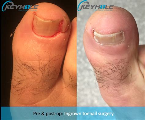 Ingrown Toenail Surgery Perth | Perth Podiatric Surgery