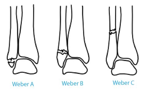 Ankle fracture: natural healing