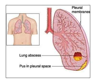 Lung Abscess - Standard Treatment Guidelines - Medical Dialogues