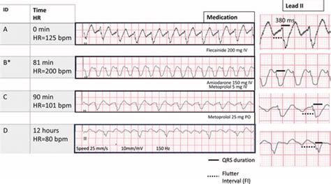 Ventricular Flutter Vs Fibrillation