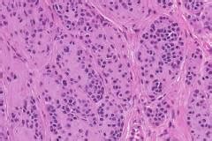 Dermal nevus | Ottawa Atlas of Pathology